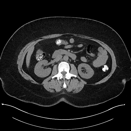 Carcinoid tumor - terminal ileum (Radiopaedia 60931-68740 Axial non-contrast 50).jpg