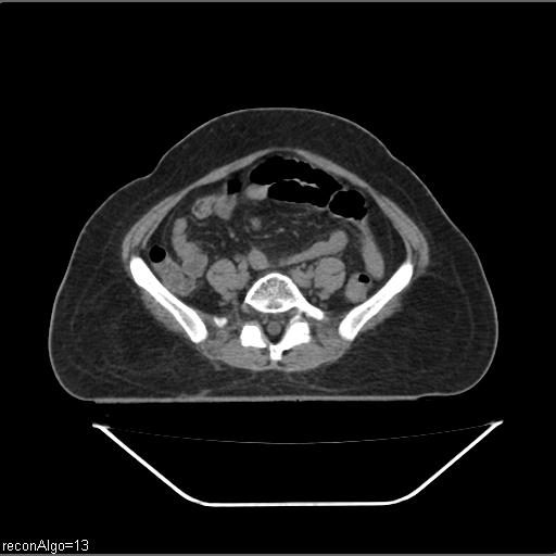 File:Carcinoma cervix- brachytherapy applicator (Radiopaedia 33135-34173 Axial non-contrast 1).jpg