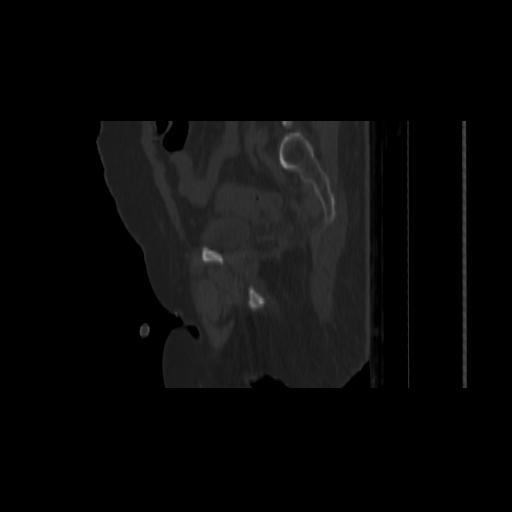 Carcinoma cervix- brachytherapy applicator (Radiopaedia 33135-34173 Sagittal bone window 129).jpg