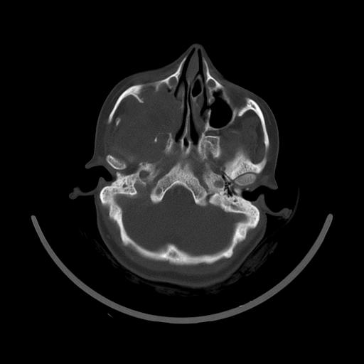 Carcinoma of the maxillary antrum (Radiopaedia 53805-59888 Axial bone window 42).jpg