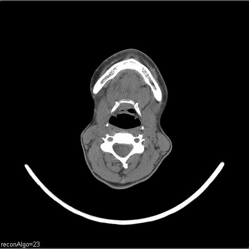 File:Carcinoma of the maxillary antrum (Radiopaedia 53805-59888 Axial non-contrast 34).jpg