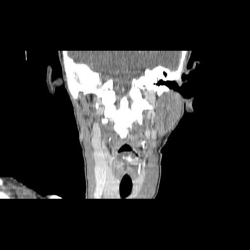 File:Carcinoma of the maxillary antrum (Radiopaedia 53805-59888 Coronal C+ delayed 104).jpg