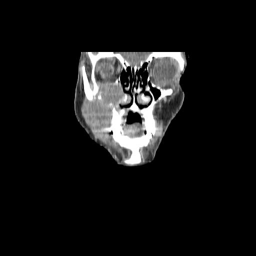 Carcinoma of the maxillary antrum (Radiopaedia 53805-59888 Coronal C+ delayed 26).jpg