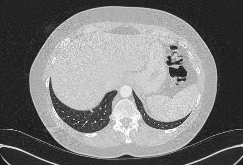 File:Cardiac sarcoidosis (Radiopaedia 74548-85534 Axial lung window 81).jpg