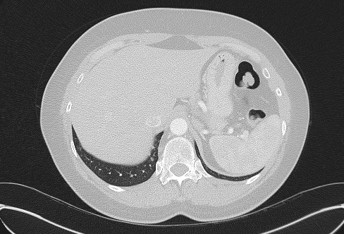 File:Cardiac sarcoidosis (Radiopaedia 74548-85534 Axial lung window 85).jpg