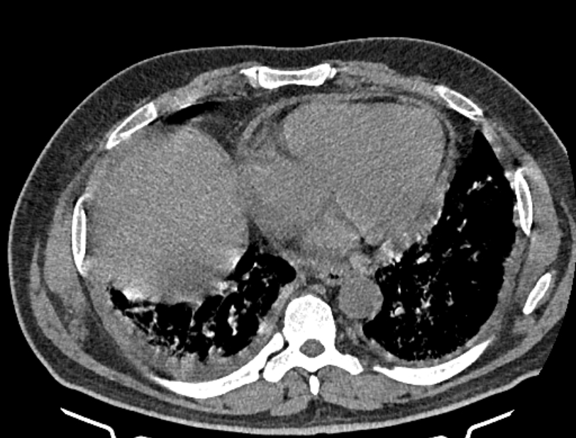 Cardiogenic pulmonary edema (Radiopaedia 68180-77678 Axial non-contrast 36).jpg