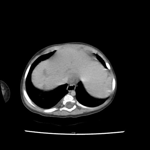 Caroli disease with autosomal recessive polycystic kidney disease (ARPKD) (Radiopaedia 89651-106703 B 18).jpg
