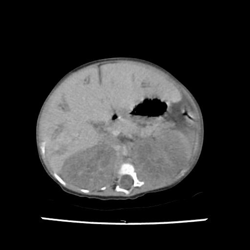 File:Caroli disease with autosomal recessive polycystic kidney disease (ARPKD) (Radiopaedia 89651-106703 B 80).jpg