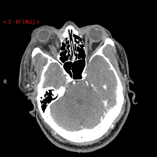 Caroticocavernous fistula (Radiopaedia 42346-45457 B 18).jpg
