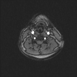 File:Carotid artery dissection (Radiopaedia 28441-28689 Axial MRA 36).jpg