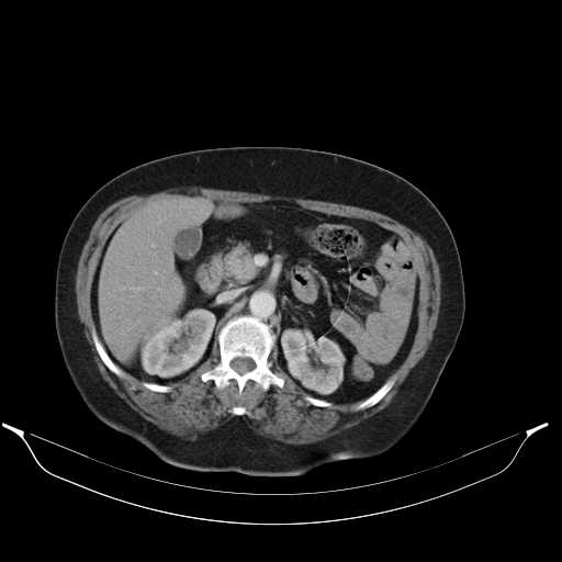 File:Carotid body tumor (Radiopaedia 21021-20948 A 60).jpg