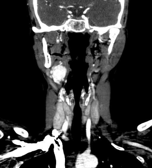 Carotid body tumor (Radiopaedia 39845-42300 C 14).jpg