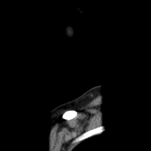 File:Carotid body tumor (paraganglioma) (Radiopaedia 38586-40729 C 3).jpg