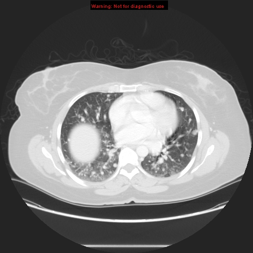 Carotid body tumor with lung metastases (Radiopaedia 9301-48390 Axial lung window 41).jpg