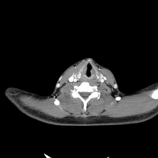 Carotid bulb pseudoaneurysm (Radiopaedia 57670-64616 A 50).jpg