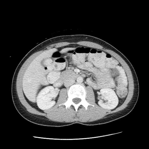 File:Castleman disease with fibrous pseudotumor in the abdomen (Radiopaedia 77296-89373 A 53).jpg