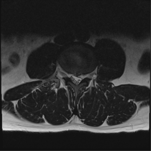 File:Cauda equina syndrome (Radiopaedia 53615-59672 Axial T2 20).png