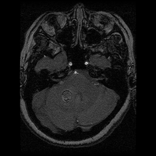 Cavernoma, DVA and right ICA aneurysm (Radiopaedia 33890-35072 E 78).png