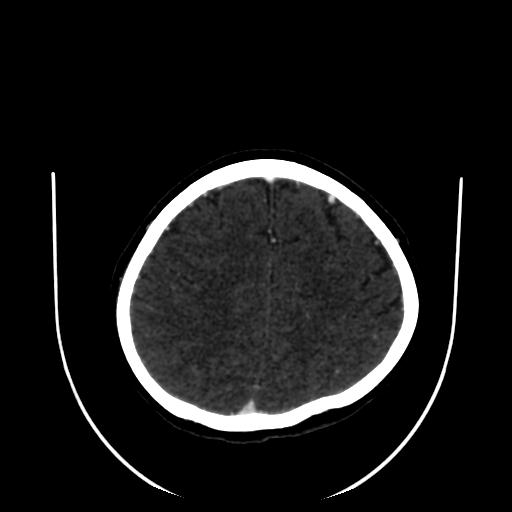 Cavernoma with developmental venous anomaly (Radiopaedia 22470-22506 C 145).jpg