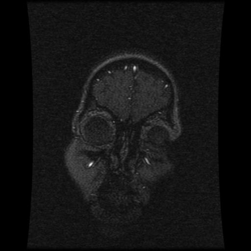 Cavernoma with developmental venous anomaly (Radiopaedia 22470-22507 MRV 114).jpg