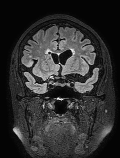 Cavernous hemangioma of the cerebellar falx (Radiopaedia 73025-83724 Coronal FLAIR 119).jpg