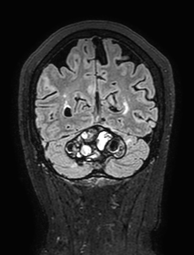 Cavernous hemangioma of the cerebellar falx (Radiopaedia 73025-83724 Coronal FLAIR 279).jpg