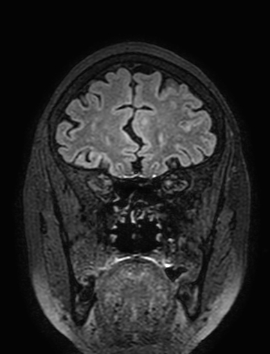 Cavernous hemangioma of the cerebellar falx (Radiopaedia 73025-83724 Coronal FLAIR 84).jpg