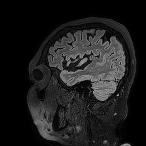 Cavernous hemangioma of the cerebellar falx (Radiopaedia 73025-83724 Sagittal FLAIR 177).jpg