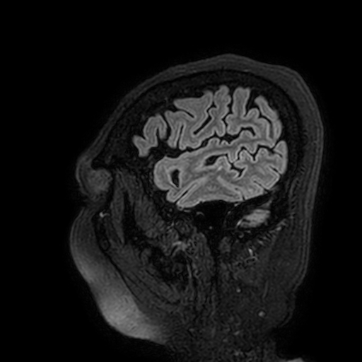 File:Cavernous hemangioma of the cerebellar falx (Radiopaedia 73025-83724 Sagittal FLAIR 21).jpg