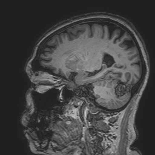 File:Cavernous hemangioma of the cerebellar falx (Radiopaedia 73025-83724 Sagittal T1 76).jpg