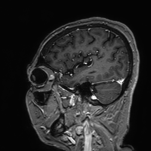 File:Cavernous hemangioma of the cerebellar falx (Radiopaedia 73025-83724 Sagittal T1 C+ 48).jpg