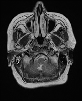 File:Cavernous sinus meningioma (Radiopaedia 63682-72367 Axial T2 3).jpg
