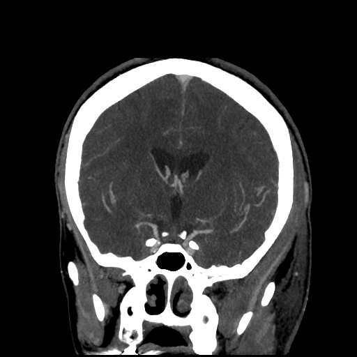 File:Cavernous sinus thrombosis (Radiopaedia 10619-11078 D 12).jpg