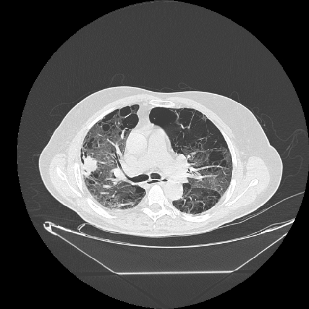 Cavitating bronchogenic carcinoma (Radiopaedia 44489-48162 Axial lung window 33).jpg