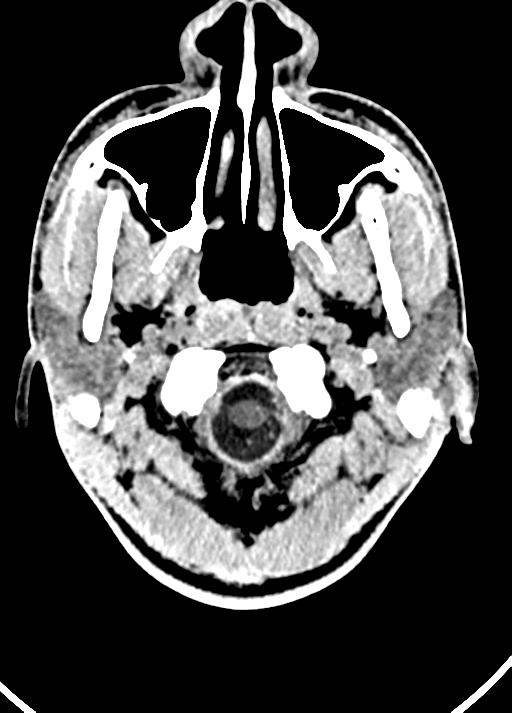 Cavum septum pellucidum and cavum vergae (Radiopaedia 77797-90060 Axial Brain Window 6).jpg