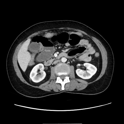 Cecal adenocarcinoma (Radiopaedia 75909-87331 A 42).jpg