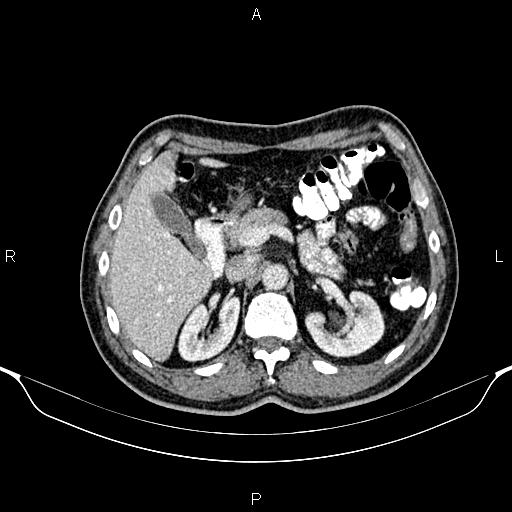 Cecal adenocarcinoma (Radiopaedia 85324-100916 B 29).jpg