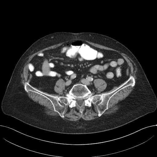 Cecal adenocarcinoma - surgical scar recurrence (Radiopaedia 79988-93264 C 47).jpg