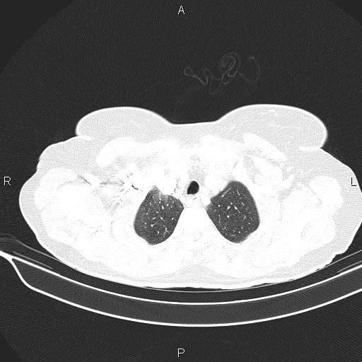 Cecal cancer (Radiopaedia 85610-101358 Axial lung window 10).jpg