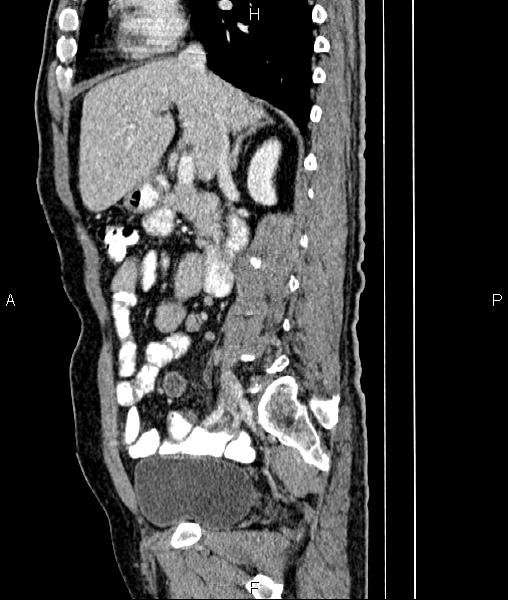 Cecal cancer with appendiceal mucocele (Radiopaedia 91080-108651 E 39).jpg
