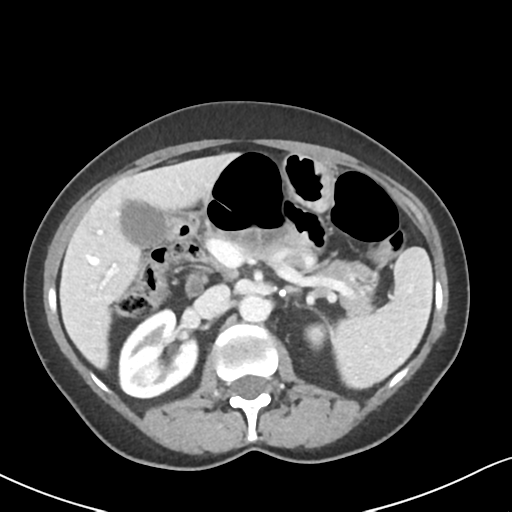 Cecal internal hernia through the foramen of Winslow (Radiopaedia 44820-48651 B 26).png