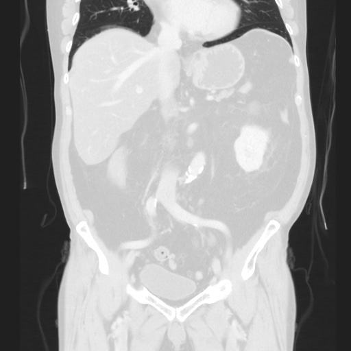 Cecal volvulus (Radiopaedia 75378-86620 Coronal lung window 74).jpg