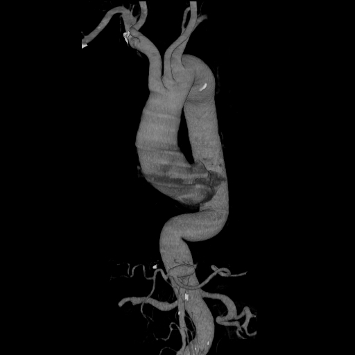File:Celiac artery aneurysm (Radiopaedia 21574-21525 C 19).JPEG