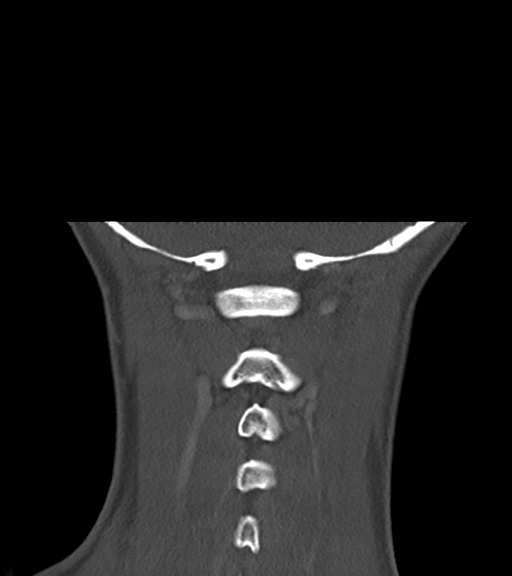 Cemento-ossifying fibroma (Radiopaedia 46243-50643 Coronal bone window 52).png