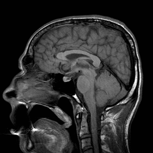 File:Central-variant posterior reversible encephalopathy syndrome (PRES) (Radiopaedia 43880-47358 Sagittal T1 12).jpg