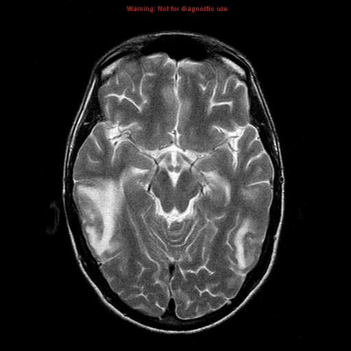 File:Central nervous system vasculitis (Radiopaedia 8410-9235 Axial T2 10).jpg
