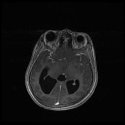 Central neurocytoma (Radiopaedia 30220-30842 Axial T1 C+ 70).jpg
