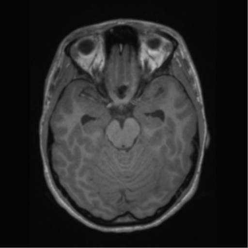 File:Central neurocytoma (Radiopaedia 37664-39557 Axial T1 26).png