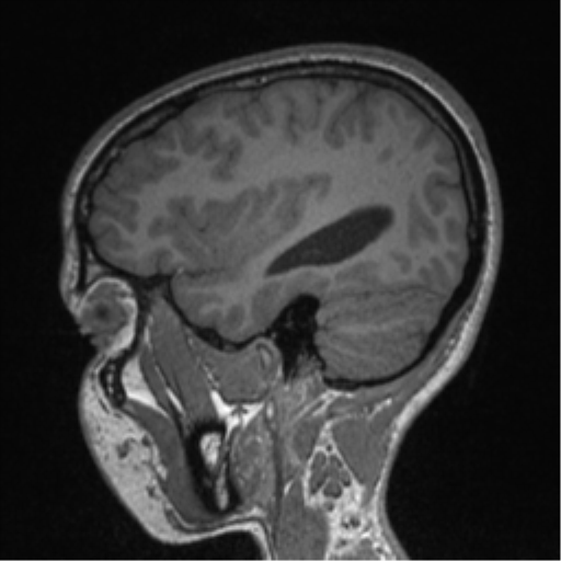 Central neurocytoma (Radiopaedia 37664-39557 Sagittal T1 26).png