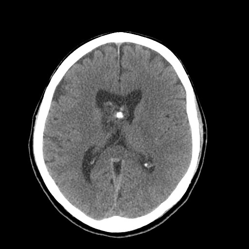 Central neurocytoma (Radiopaedia 68725-78432 Axial non-contrast 29).jpg